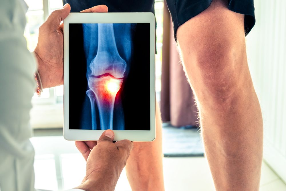 Osteoartróza: príčiny, príznaky a ako jej predchádzať?